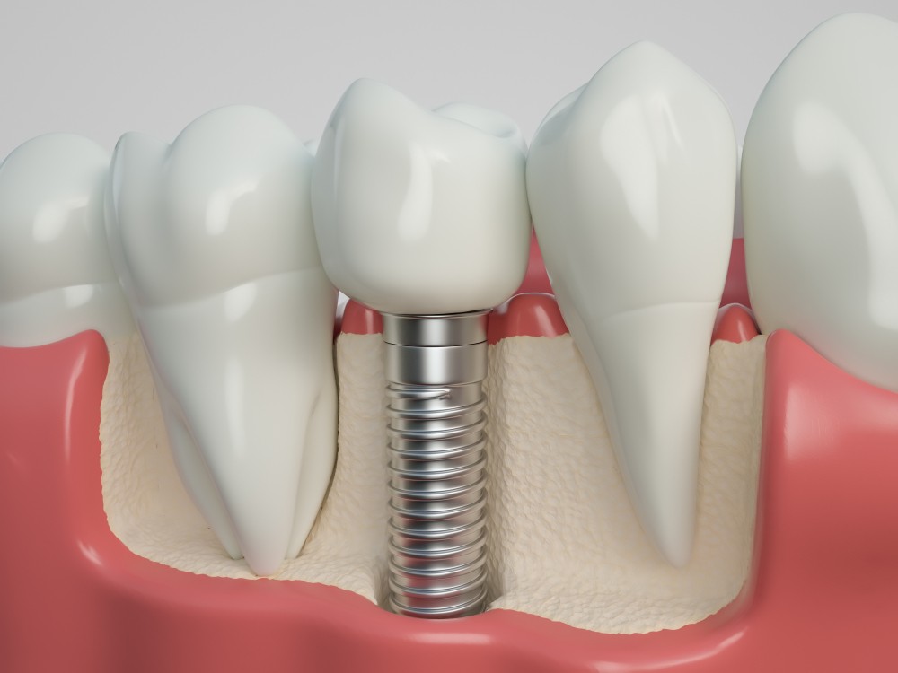 implant dentar targoviste, implantologie targoviste, clinica stomatologica targoviste rg dental